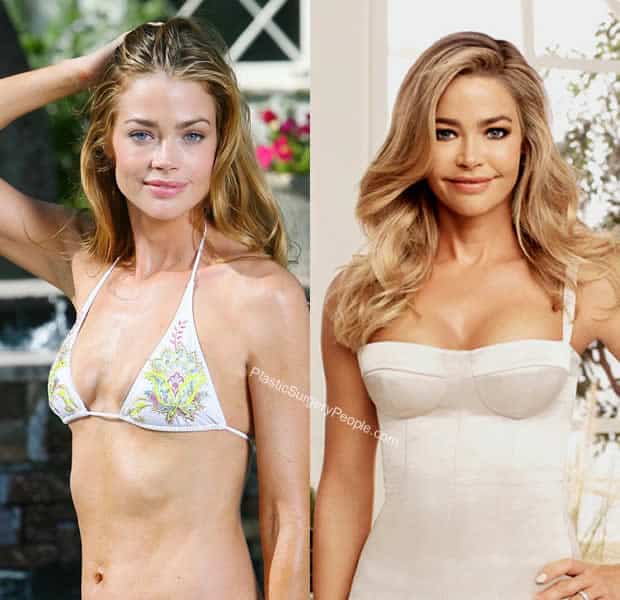 Denise Richards breast implants before and after