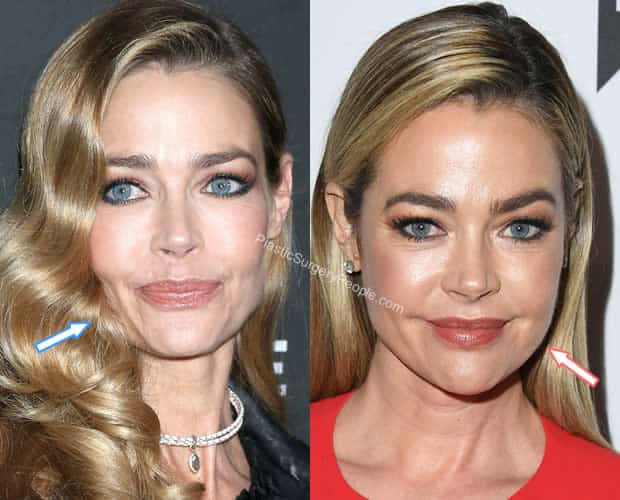 Denise Richards facelift before and after
