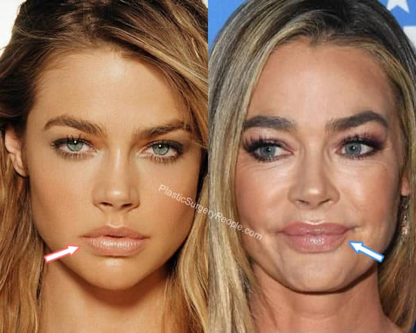 Denise Richards lip fillers before and after