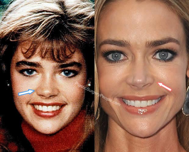 Denise Richards nose job before and after