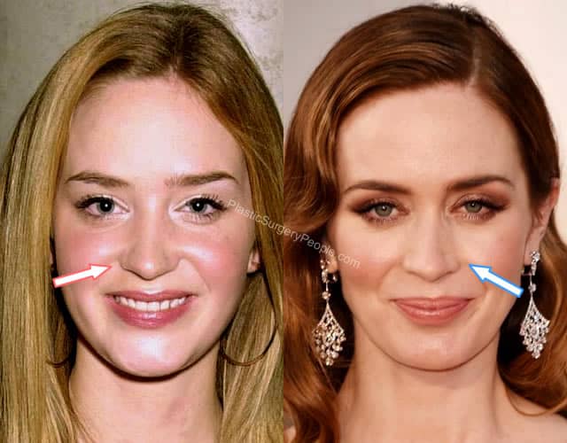 Emily Blunt nose job Before and After