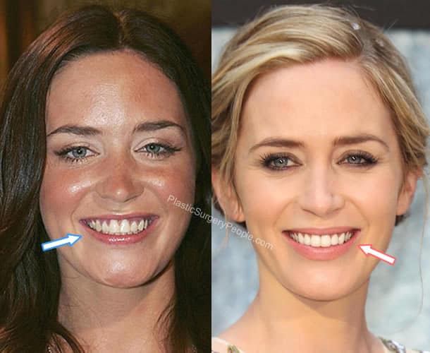 Emily Blunt's teeth before and after