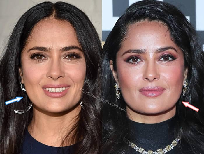 Salma Hayek botox and facelift - Before and After