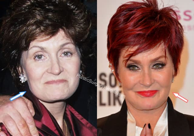 Sharon Osbourne botox before and after
