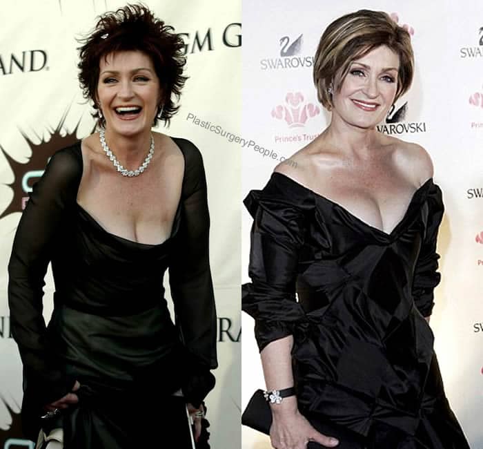 Sharon Osbourne breast implants before and after