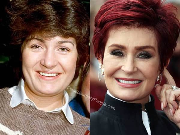 Sharon Osbourne's face before and after