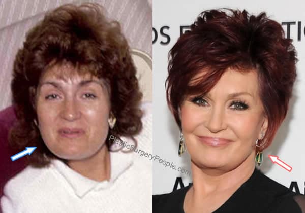 Sharon Osbourne facelift before and after