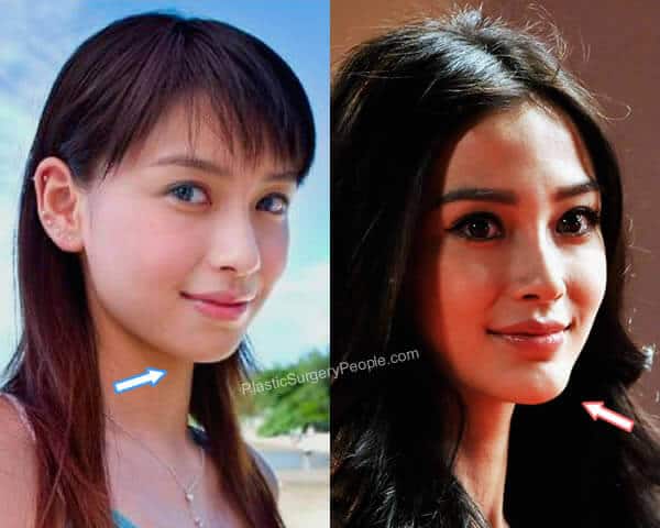 Angelababy Chin Implant Before and After