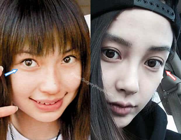 Angelababy Eye Surgery Before and After
