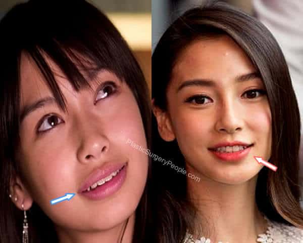 Angelababy lip reduction before and after