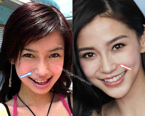 Angelababy Nose Job Before and After
