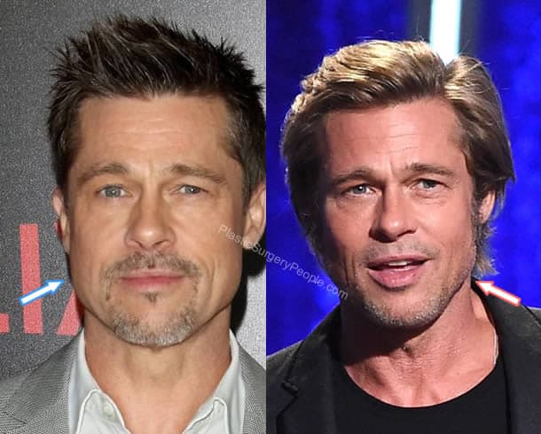 Brad Pitt botox and facelift: Before and After