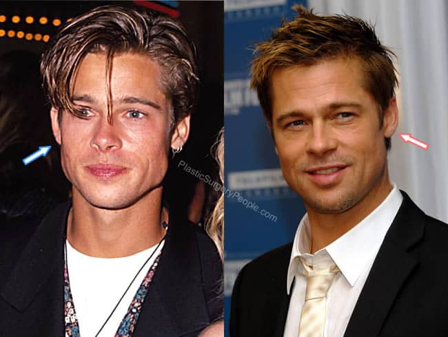 Brad Pitt ears before and after