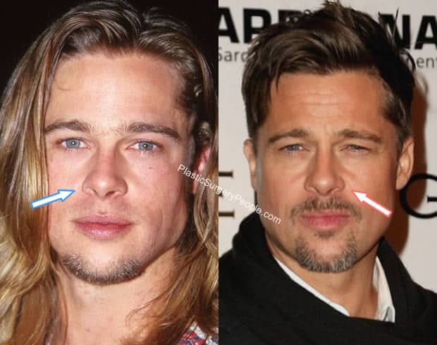 Brad Pitt nose job before and after