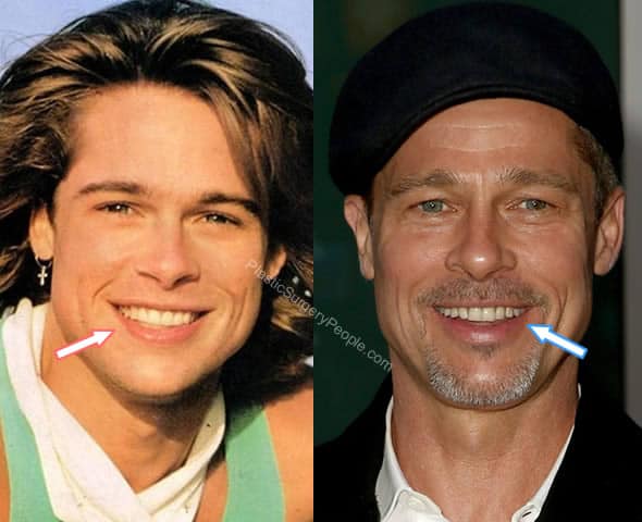 Brad Pitt teeth before and after