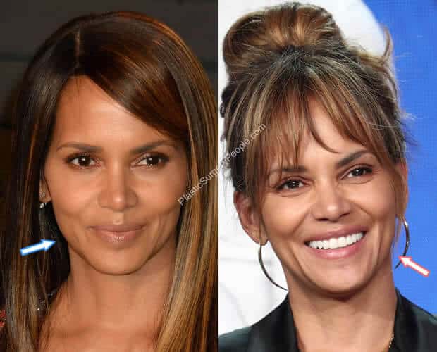Halle Berry Botox Before and After