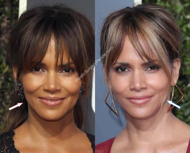 Halle Berry Facelift Before and After