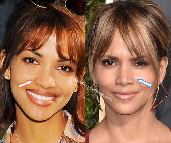 Halle Berry Nose Job Before and After