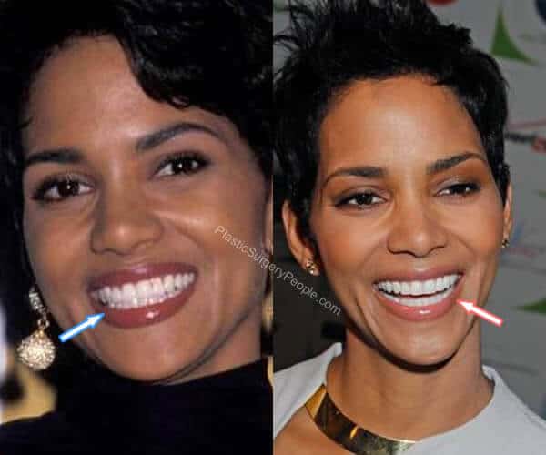 Halle Berry Teeth Before and After
