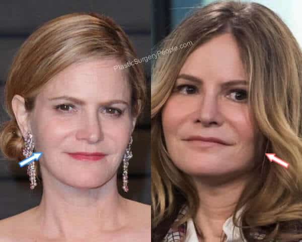 Jennifer Jason Leigh botox before and after