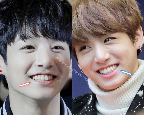 Jungkook teeth before and after