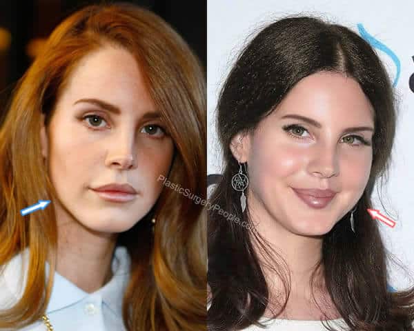 Lana Del Rey botox before and after