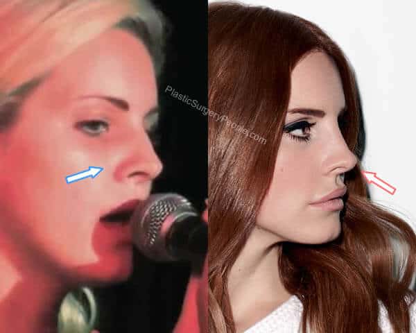 Lana Del Rey nose job before and after