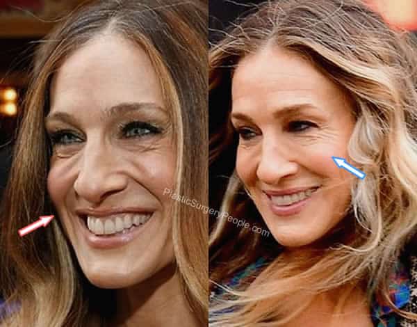 Sarah Jessica Parker botox before and after