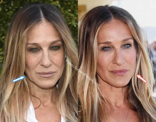 Sarah Jessica Parker facelift before and after