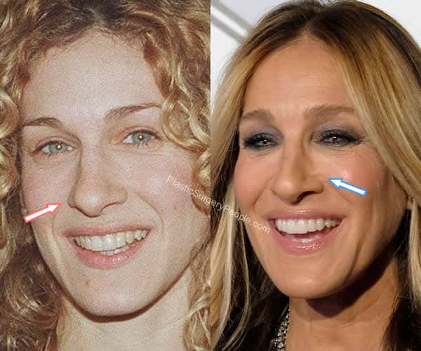 Sarah Jessica Parker rhinoplasty before and after
