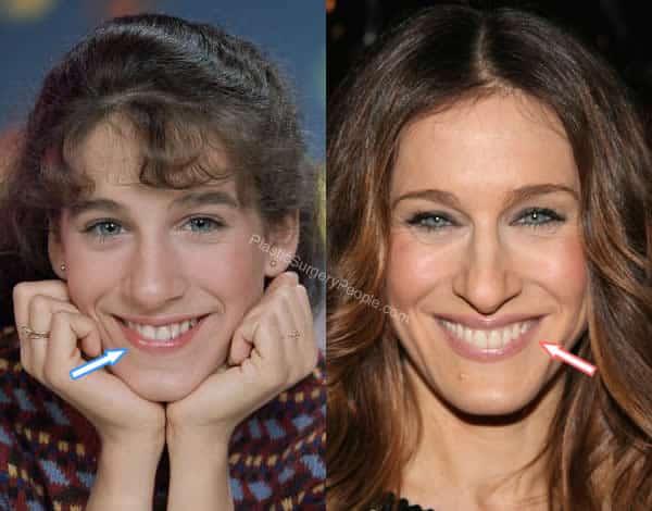 Sarah Jessica Parker teeth before and after