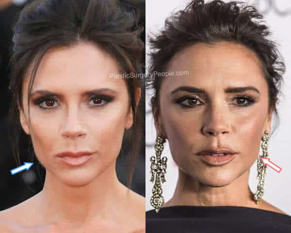 Victoria Beckham Botox Before and After
