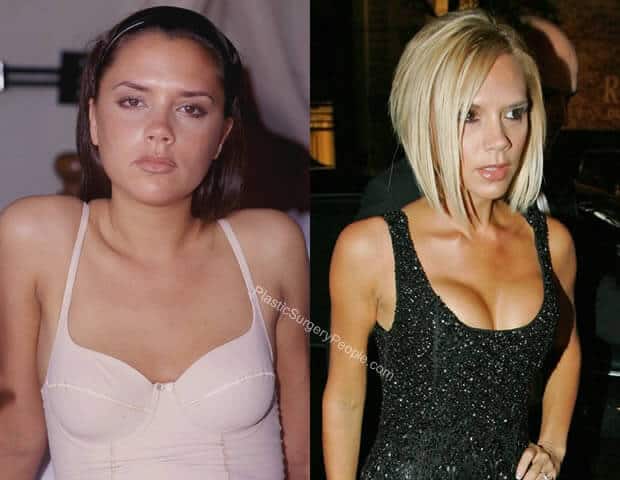 Victoria Beckham Breast Implants Before and After