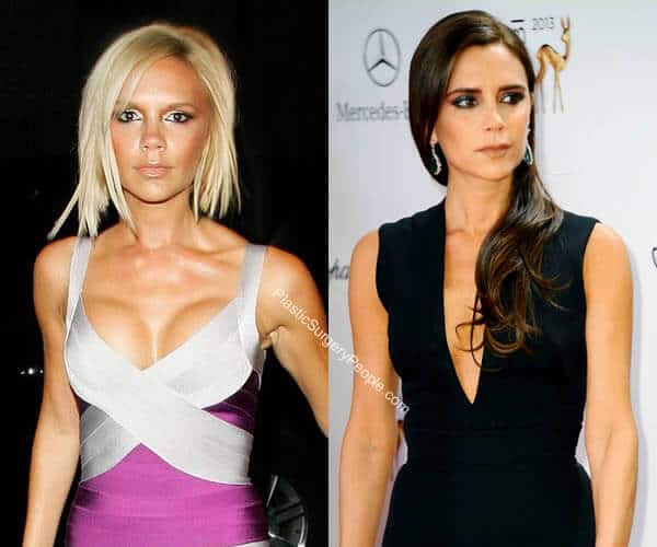 Victoria Beckham Breast Reduction Before and After