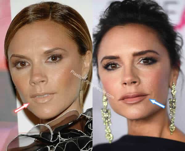 Victoria Beckham Lip Fillers Before and After