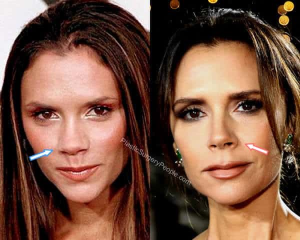 Victoria Beckham Nose Job Before and After