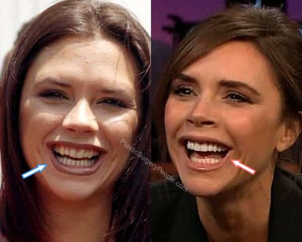 Victoria Beckham Teeth Before and After