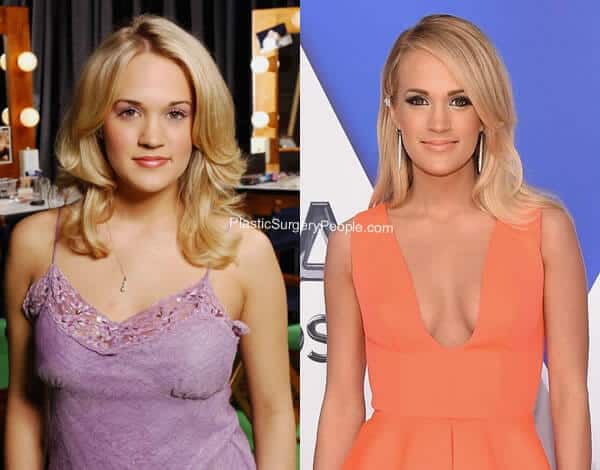 Carrie Underwood boob job before and after?