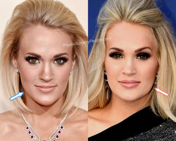 Carrie Underwood botox before and after?