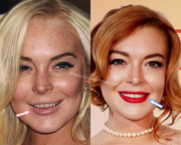 Lindsay Lohan teeth before and after