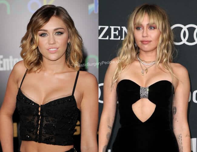 Miley Cyrus Breast Implants Before and After