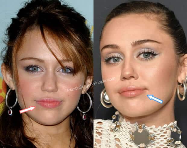 Miley Cyrus Lip Injections Before and After