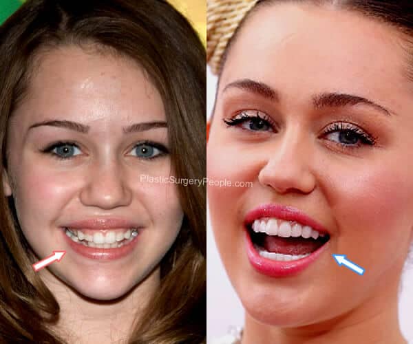 Miley Cyrus Teeth Before and After