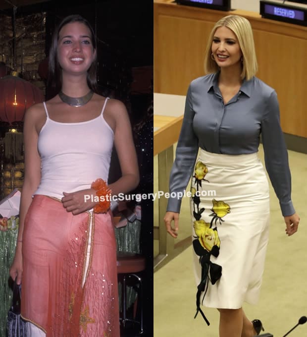Ivanka Trump breast implants before and after photo
