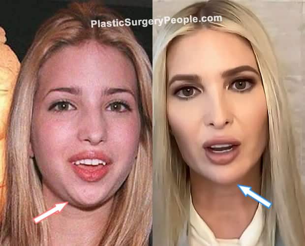 Ivanka Trump chin reduction before and after photo