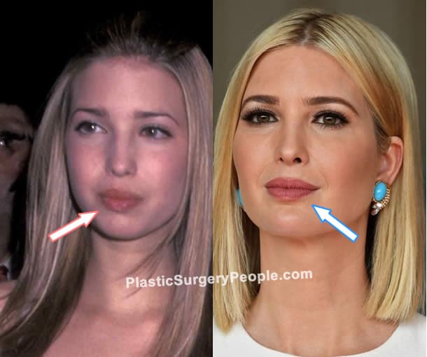 Ivanka Trump lip fillers before and after photo