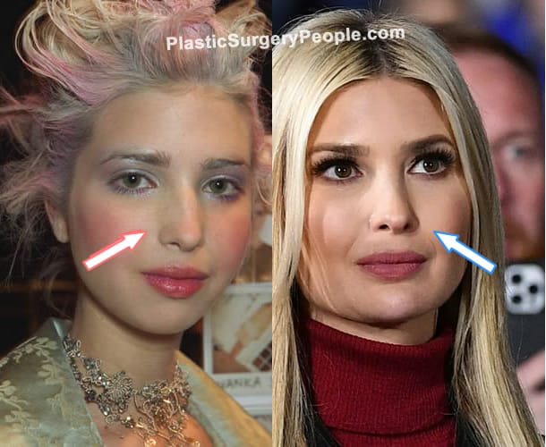 Ivanka Trump nose job before and after photo