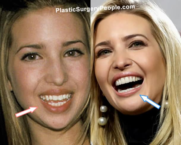 Ivanka Trump teeth before and after photo