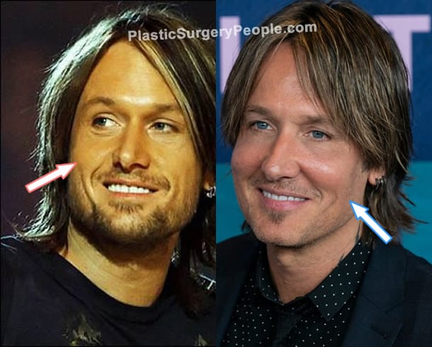 Keith Urban botox before and after photo