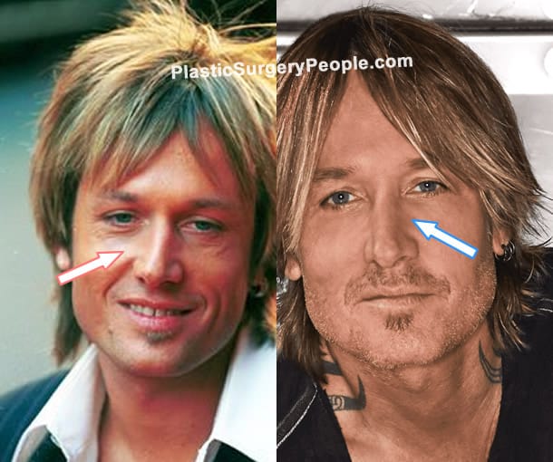 Keith Urban nose job before and after photo